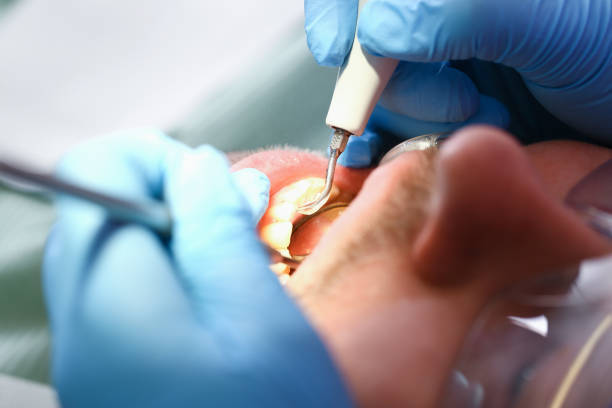 Best Emergency Root Canal Treatment in Tolono, IL